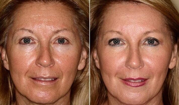 przed i po odmładzaniu skóry twarzy w domu