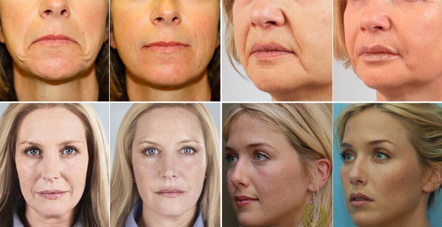 zdjęcia kobiet przed i po odmładzaniu skóry twarzy