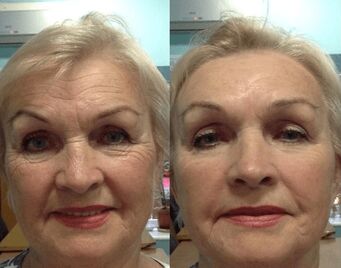 doświadczenie stosowania kremu przeciwzmarszczkowego Goji Cream - osobiste zdjęcie przed i po